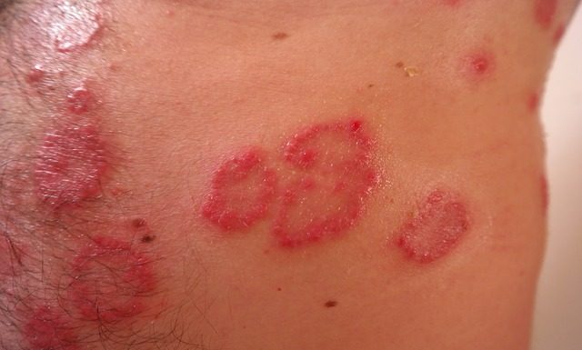 Łuszczyca – co warto wiedzieć? łuszczyca