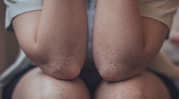 Zadbaj o swoją cerę! Oto kilka sposobów na pielęgnacje suchej skóry