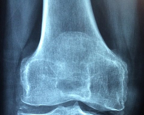 Objawy reumatyzmu Objawy reumatyzmu